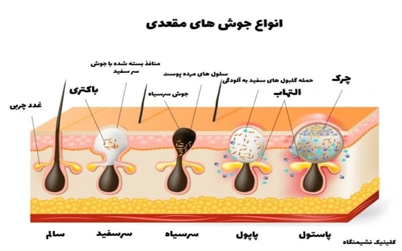 جوش مقعدی چیست؟ علت و درمان جوش اطراف مقعدی با لیزر - کلینیک نشیمنگاه