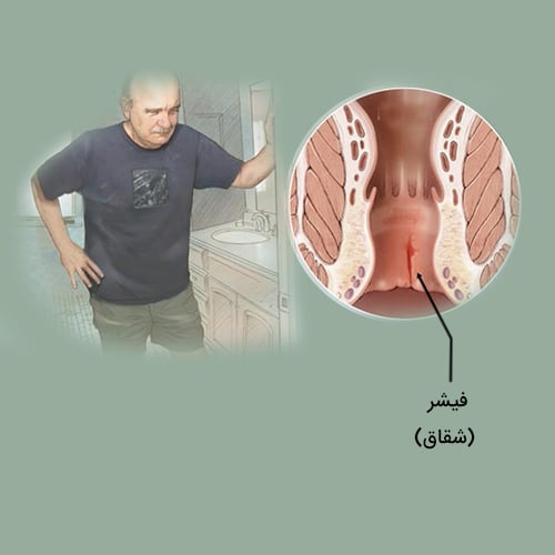 درمان شقاق یا فیشر مقعد به روش طب سنتی