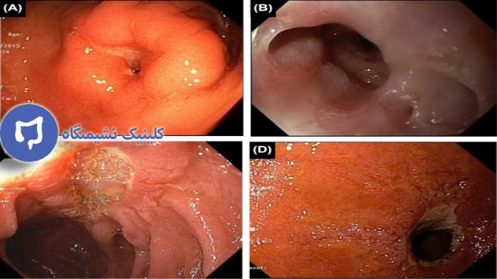 عکس تنگی مقعدی