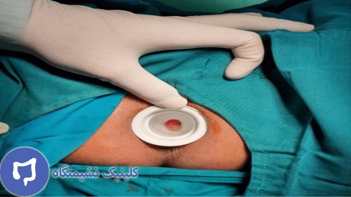 عکس درمان تنگی مقعد نوزادان