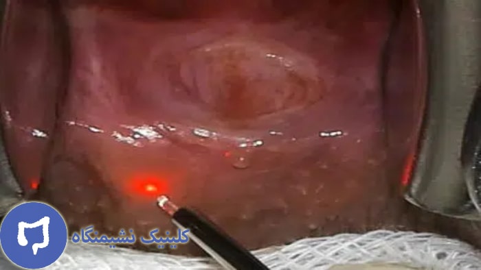 تصویر لیزر شقاق