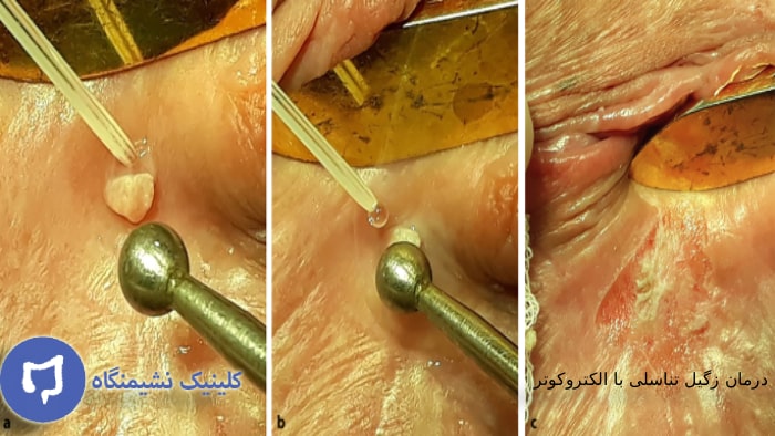 عکس درمان زگیل تناسلی با الکتروکوتر