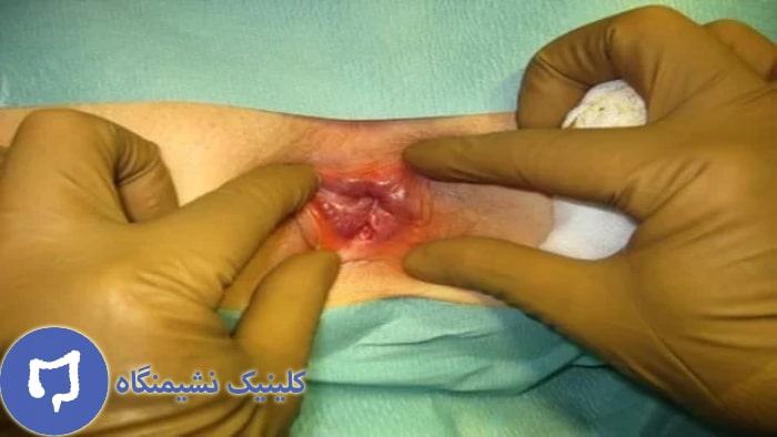 عکس جوش خوردن زخم شقاق مقعدی با پماد