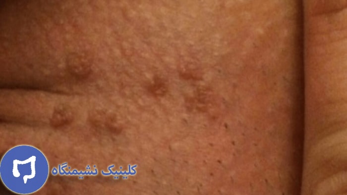 عکس پودوفیلین و تاثیر آن بر زگیل تناسلی