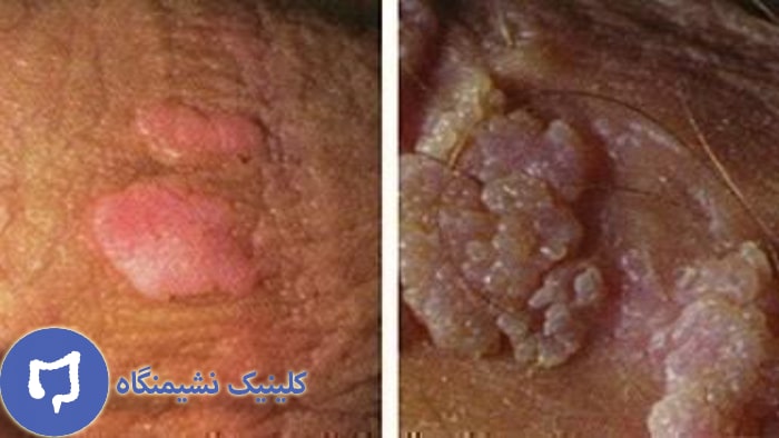 عکس عدم دریافت واکسن گارداسیل و ابتلا به زگیل