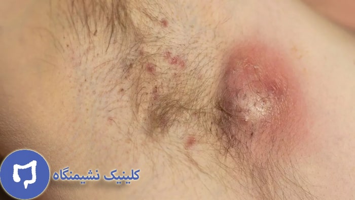 عکس درمان خانگی کیست مویی زیر بغل