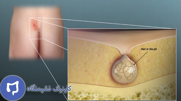 عکس سینوس مویی