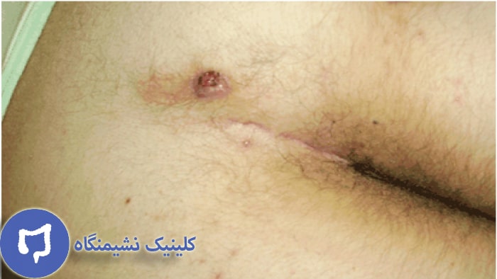 عکس درمان کیست مویی با طب سنتی