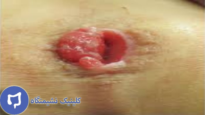 عکس بیرون زدگی رکتوم