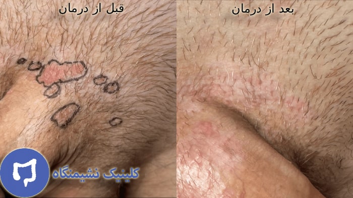 عکس خوب شدن زگیل تناسلی