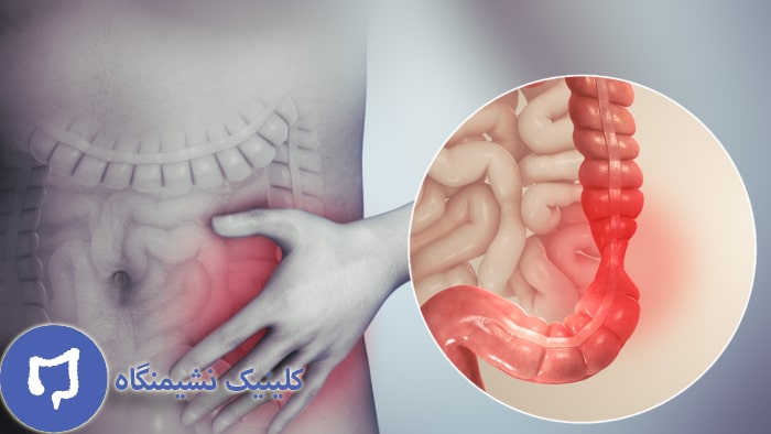 عکس عوارض سندروم روده تحریک پذیر