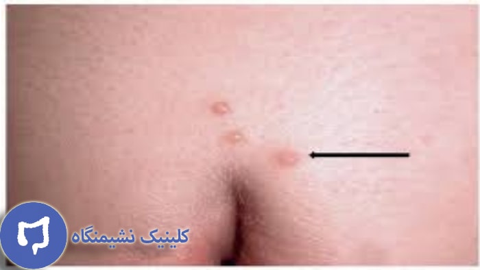 عکس زگیل تناسلی کم خطر در زنان