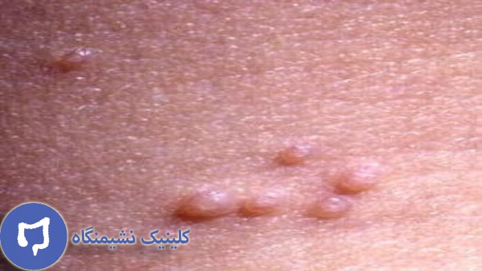 عکس زگیل تناسلی کم خطر