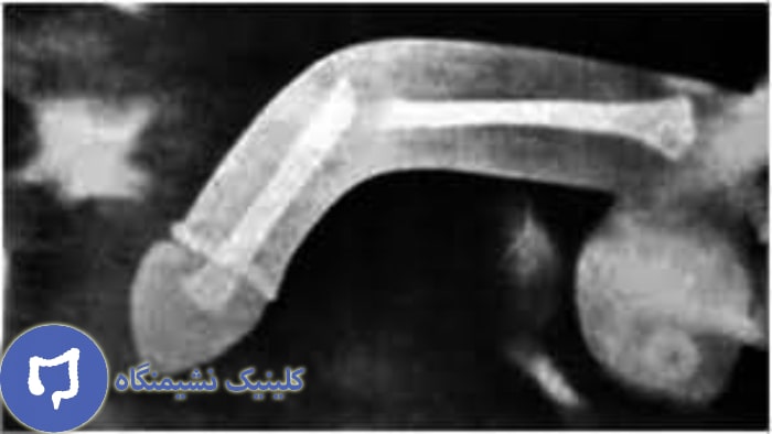 عکس شکستگی آلت در اثر رابطه مقعدی