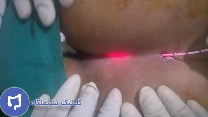 عکس لیزر کیست مویی