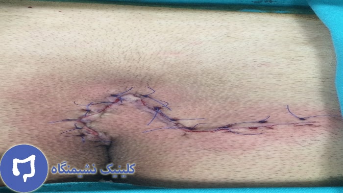 عکس عمل کیست مویی با بازسازی فلپ لیمبرگ