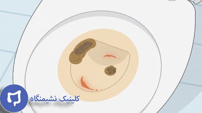 تصویر خونریزی مقعدی