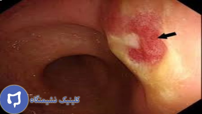 عکس خونریزی مقعدی در اثر رابطه از پشت