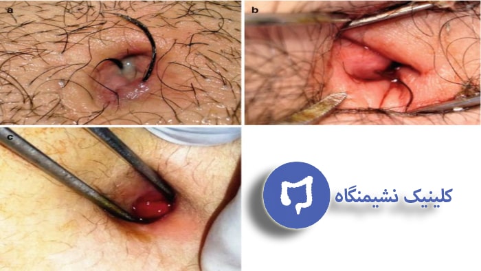 عکس سرطان کیست مویی