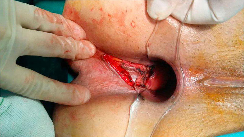تصویر عمل جراحی اسفنکتروتومی