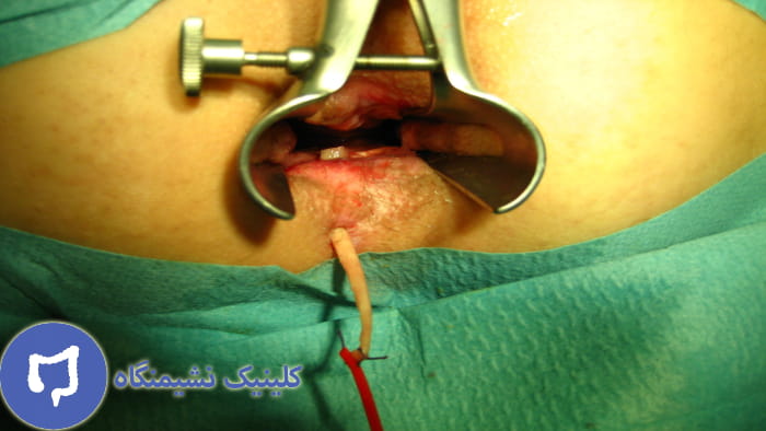 عکس فیستول سوپراسفنکتریک