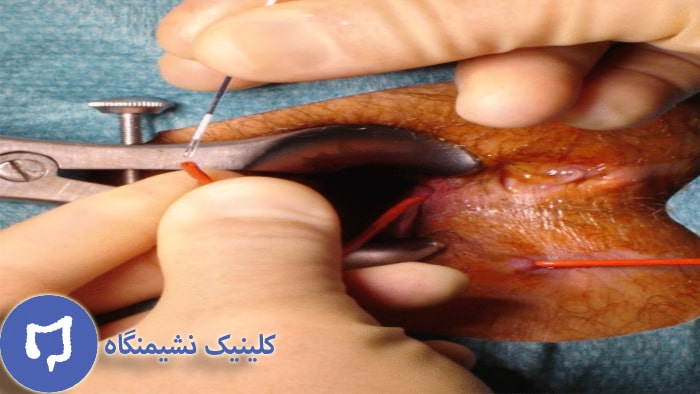 عکس درمان فیستول مقعدی 