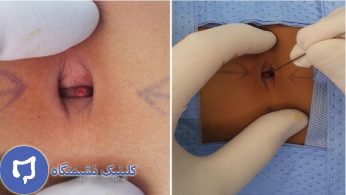 عکس فیستول ناف