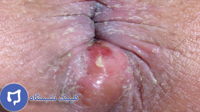 عکس ابسه مقعدی