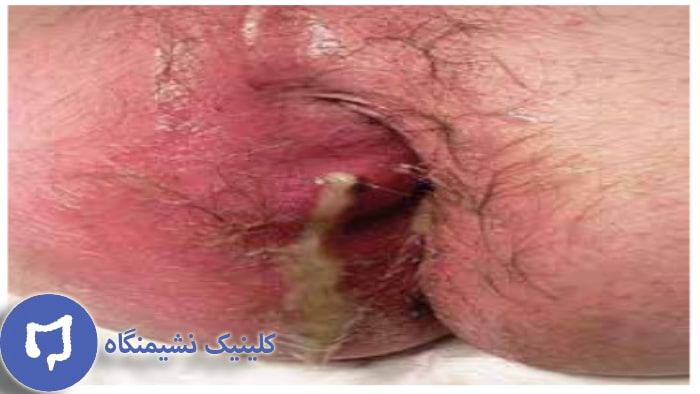 شکل آبسه مقعدی