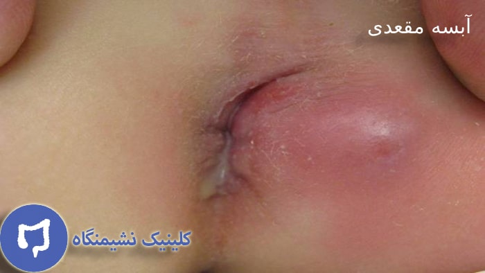عکس ابسه مقعدی در مقایسه با فیستول
