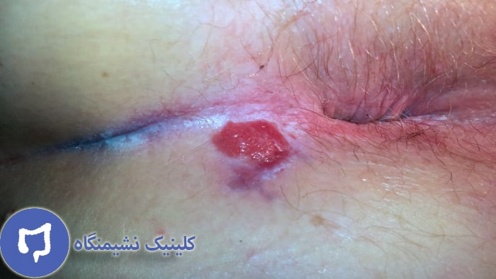 عکس سرطان مقعدی