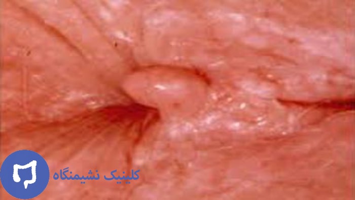 عکس گوشت اضافه مقعدی