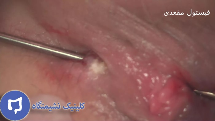 عکس فیستول مقعدی در مقایسه با آبسه مقعدی