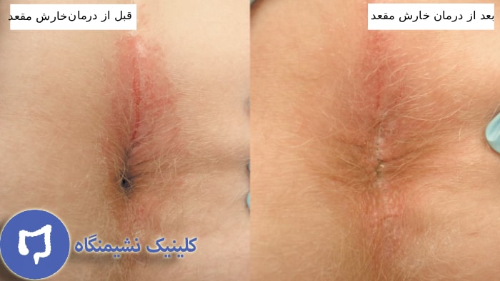 عکس قبل و بعد درمان خارش مقعد