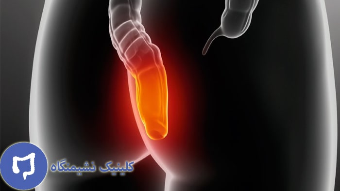 تصویر اسپاسم مقعدی