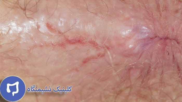 عکس زخم مقعدی