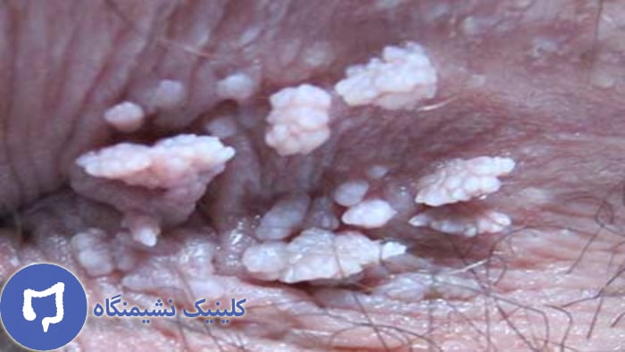 عکس زگیل مقعدی زنان