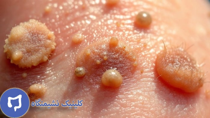 عکس زگیل مقعدی مردان