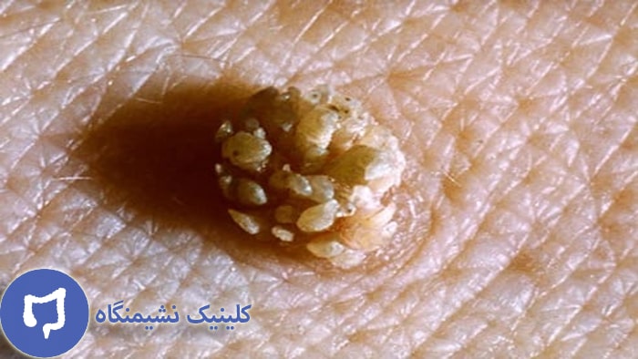 عکس زگیل مقعدی از نزدیک