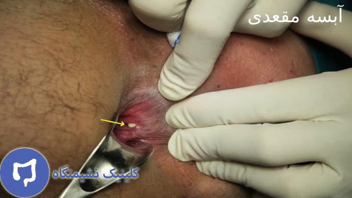 عکس علائم تبدیل آبسه به فیستول