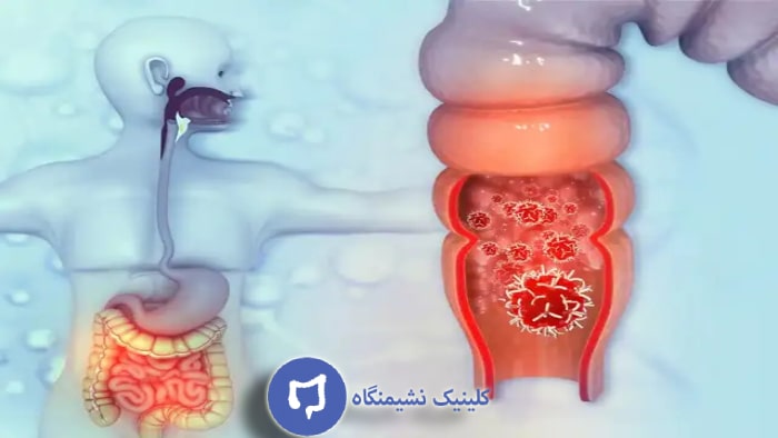 تصویر خونریزی مقعد