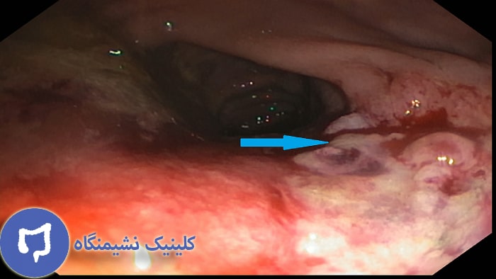 تصویر سرطان مقعدی