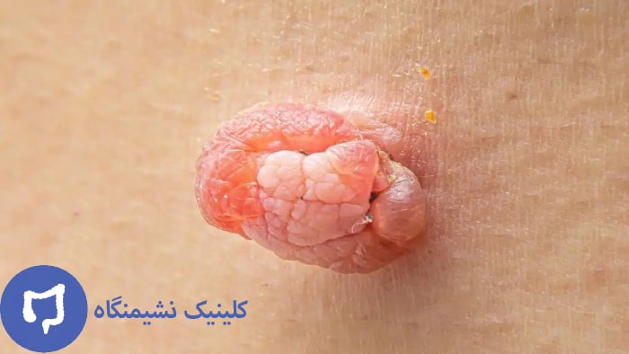 عکس از گوشت اضافه مقعدی