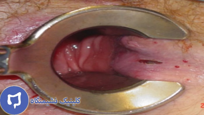 عکس شقاق مقعدی