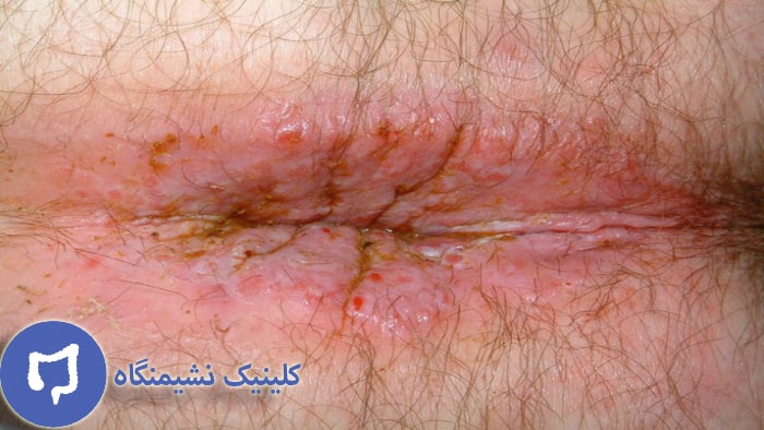 عکس خارش مقعد