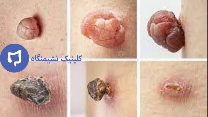 گوشت اضافه مقعدی عکس