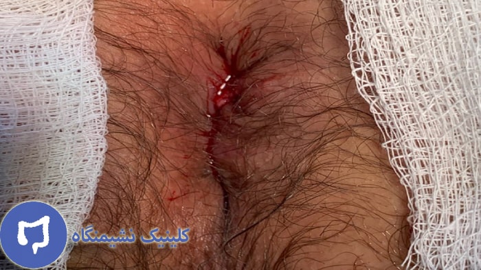 عکس زخم مقعد