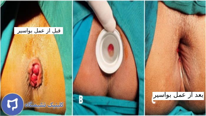 عکس قبل و بعد از عمل بواسیر