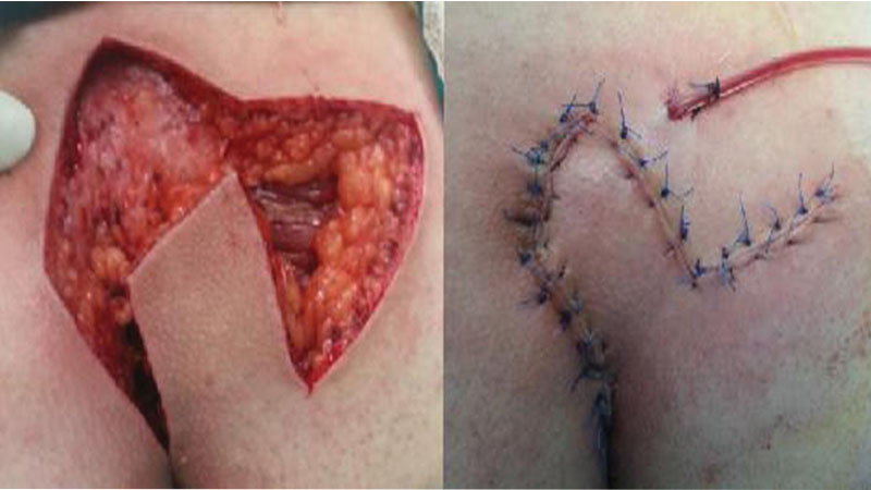 تصویر قبل و بعد از جراحی سینوس پیلونیدال