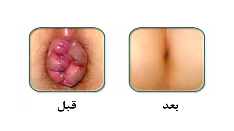 تصویر قبل و بعد از درمان بواسیر